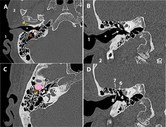 Lista de verificación de tomografía computarizada de hueso temporal y base de cráneo lateral